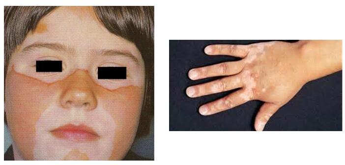 儿童斑驳病图片