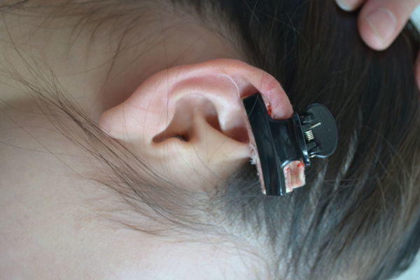 大一附院成功摘除患者右耳后重达1500克的瘢痕疙瘩