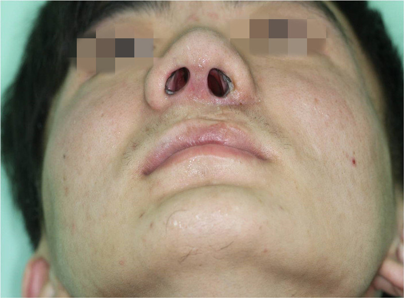 唇裂鼻畸形整复术后效果(术后6个月) - 好大夫在线