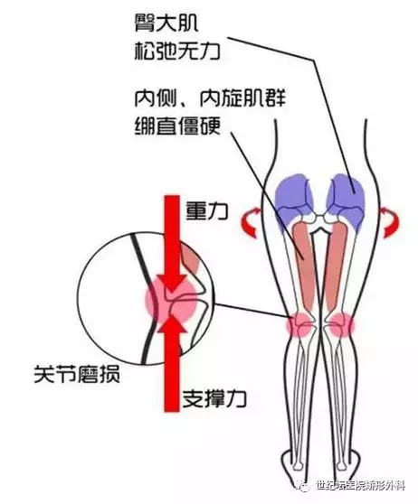 下肢力线示意图图片