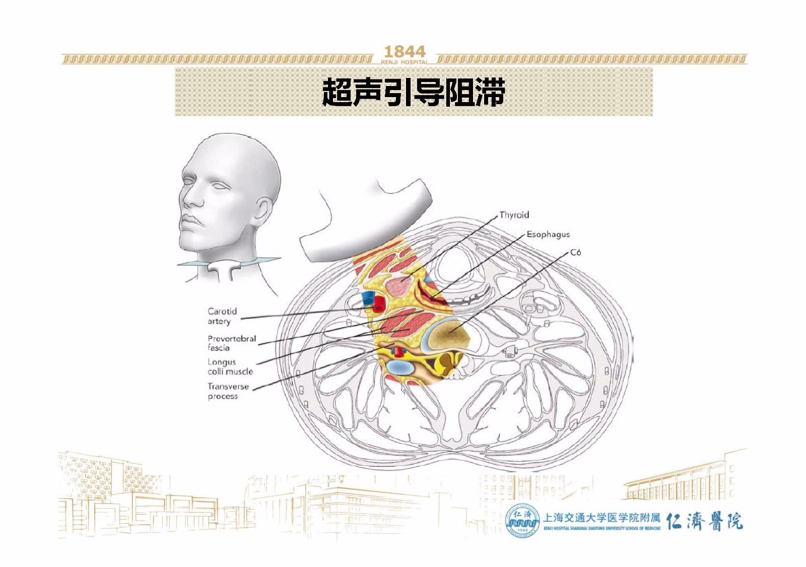 颈椎星状神经节阻滞术图片