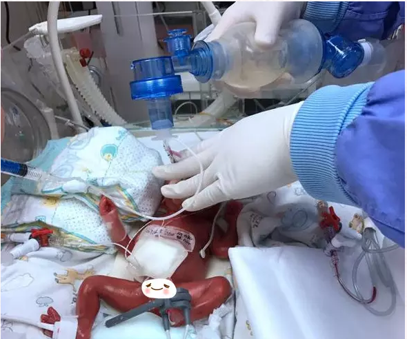最初几周,由于呼吸困难,宝宝只能使用呼吸机维持呼吸和供氧;由于不能