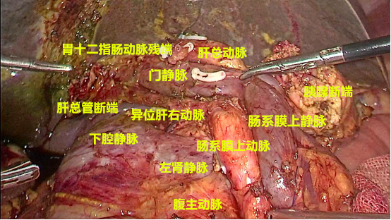 9,完整切除胰头,十二指肠,胆总管下段肿瘤后局部解剖8,游离胰腺钩突7