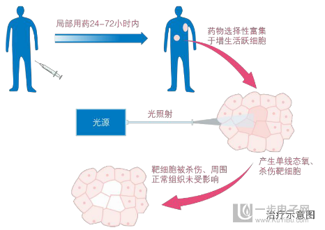 光动力疗法的简介 - 好大夫在线