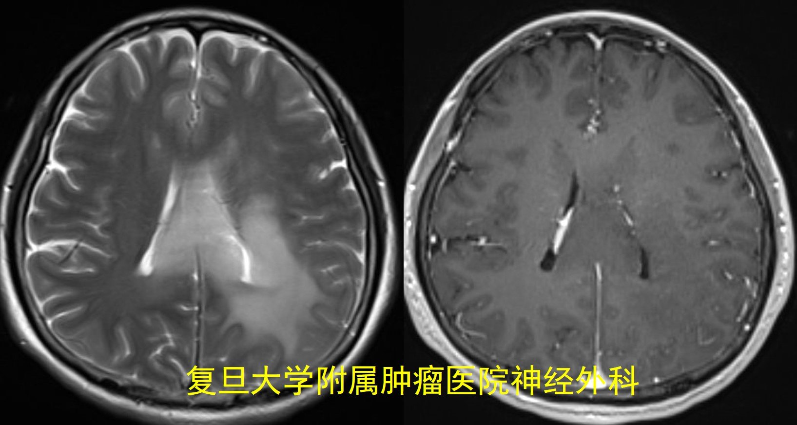 早期恶性脑瘤手术后能活多久_恶性脑瘤吃药能治愈吗_压迫视神经的脑瘤是良性还是恶性