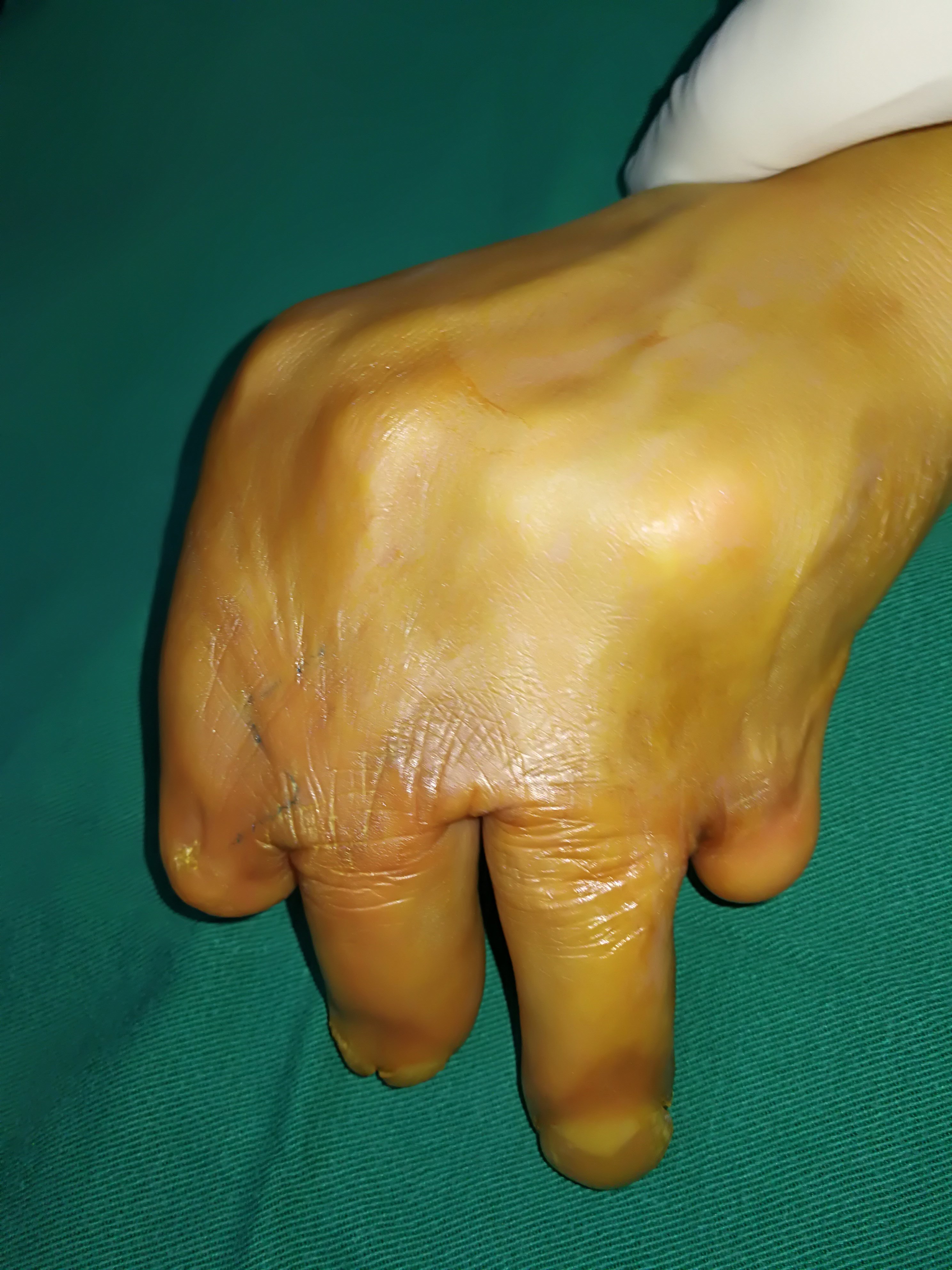 一个烧伤疤痕挛缩病例 - 好大夫在线