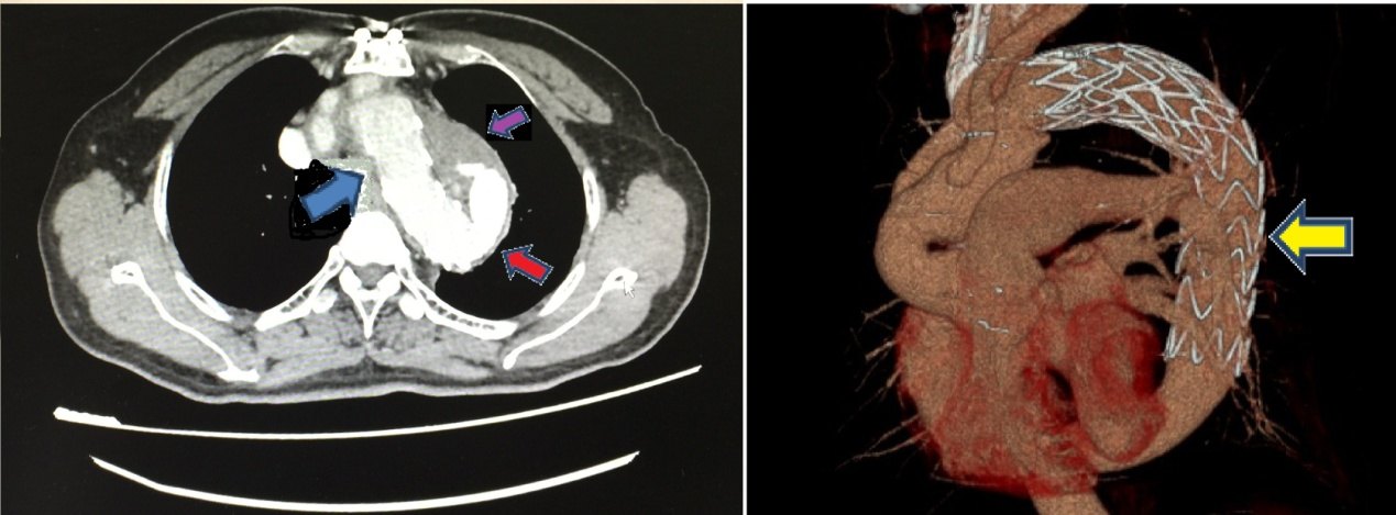 黄某一年前曾经因为主动脉弓部动脉瘤接受了全弓置换 支架象鼻手术(孙