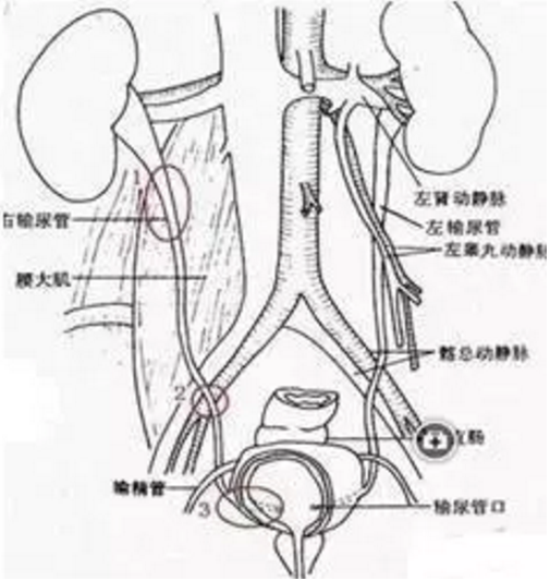 输尿管第三狭窄处图图片