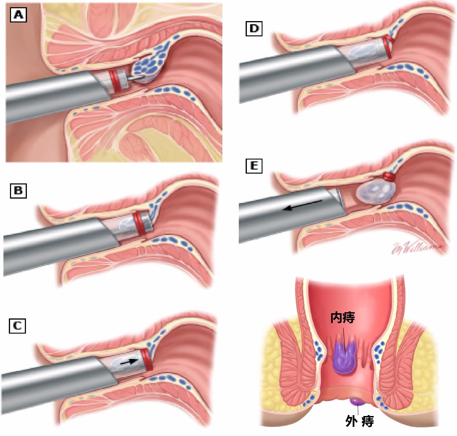 混合痔疮环切手术图解图片
