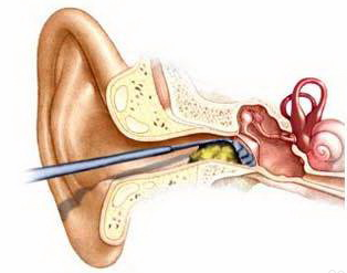 耳中耵聍是啥意思图片图片