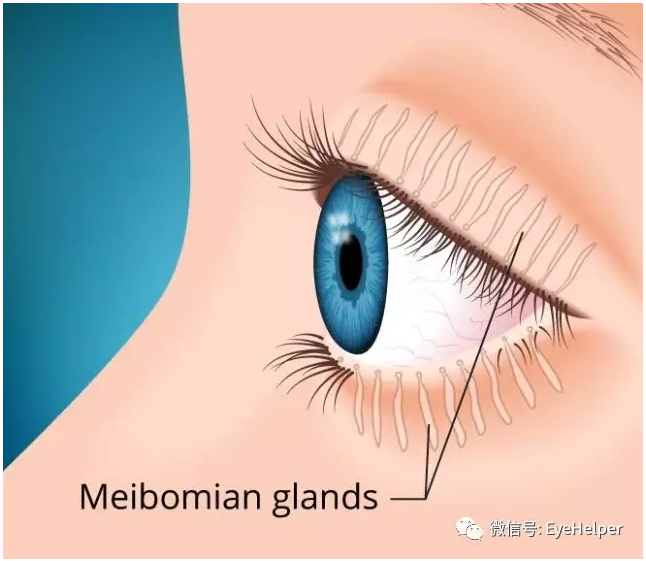 是由於瞼板腺功能障礙造成的時,絕大部分人都會甩你一臉迷茫的表情