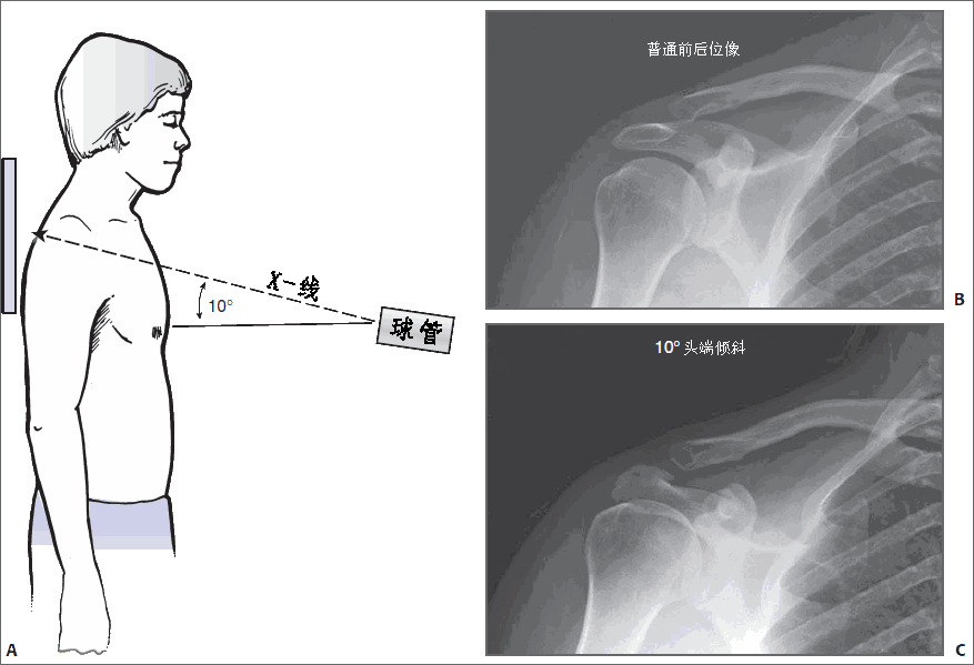 肩锁骨脱位上翘二度图片