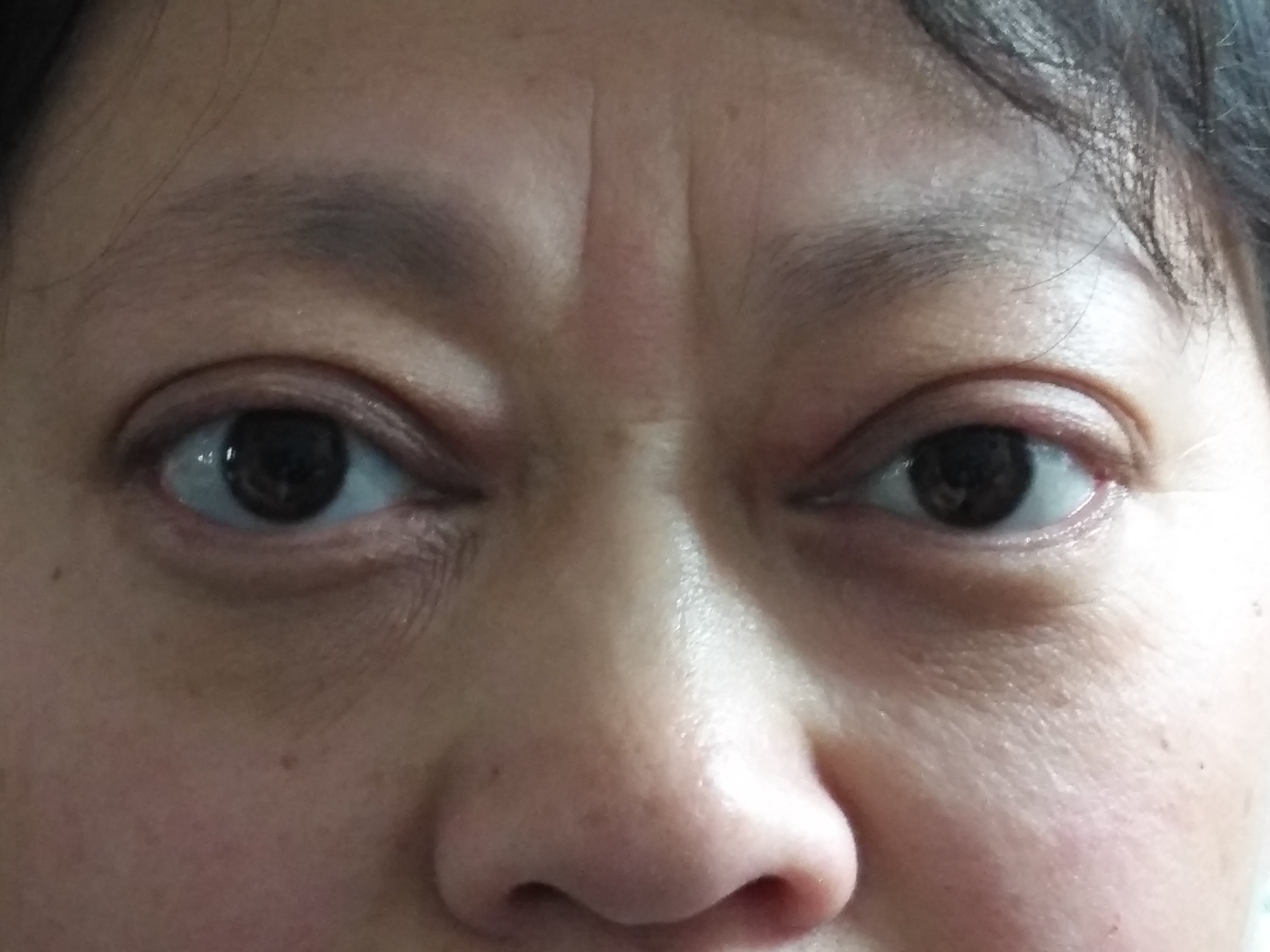 甲亢患者的眼睛图片图片