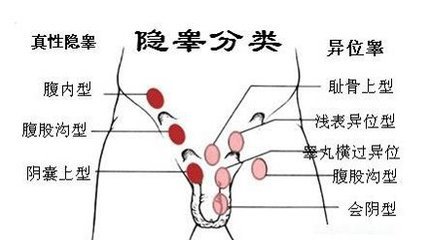 隐睾(症)谁偷了我家蛋蛋?