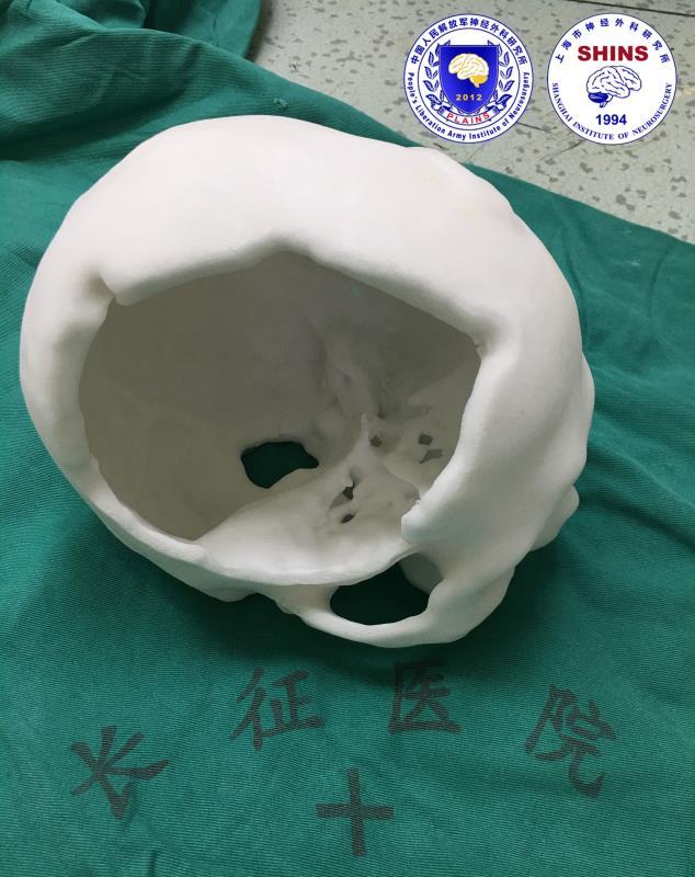 补!——颅骨修补病例及相关科普 - 好大夫在线