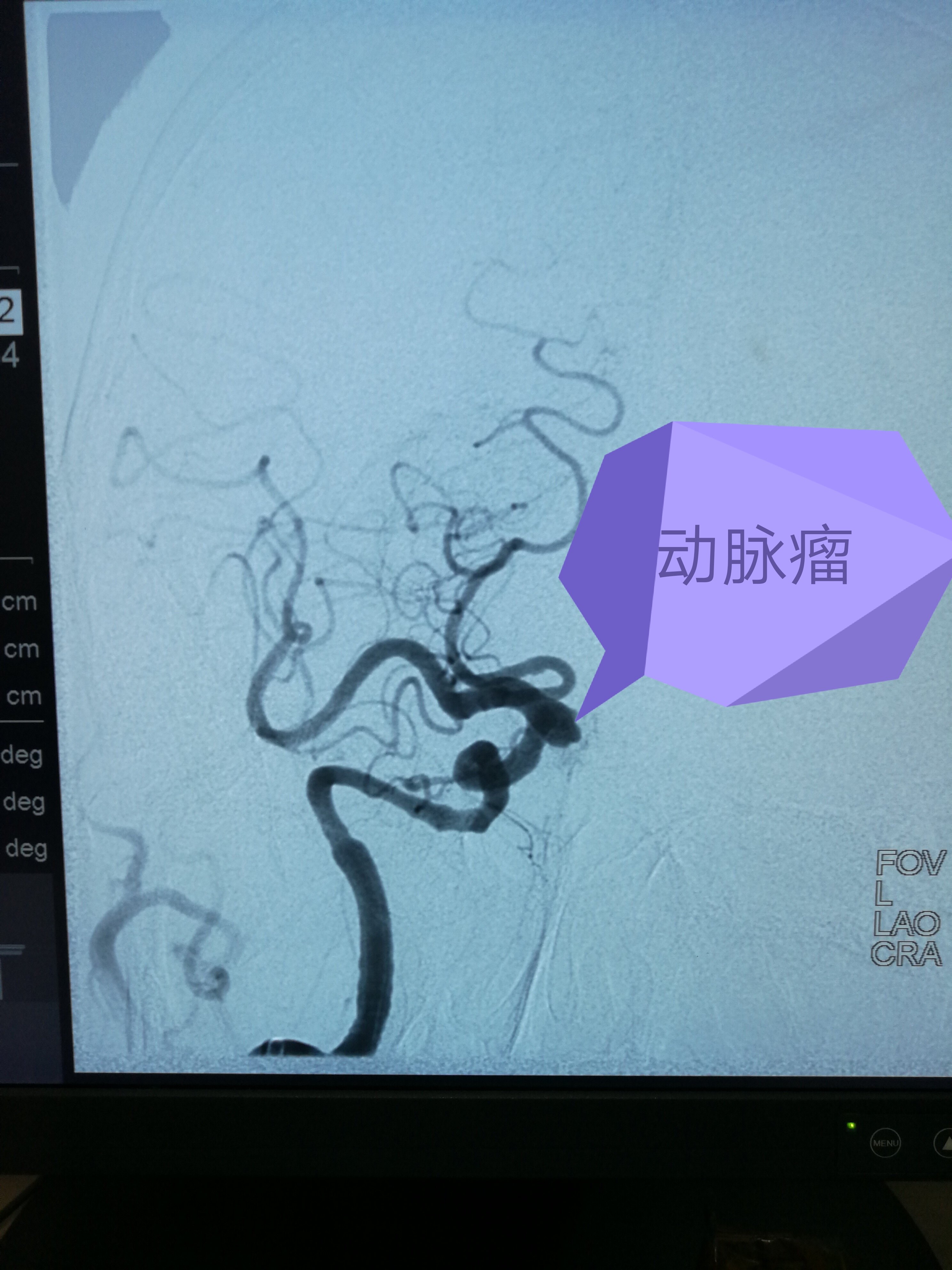 未破裂的后交通动脉瘤合并三叉神经痛 - 好大夫在线