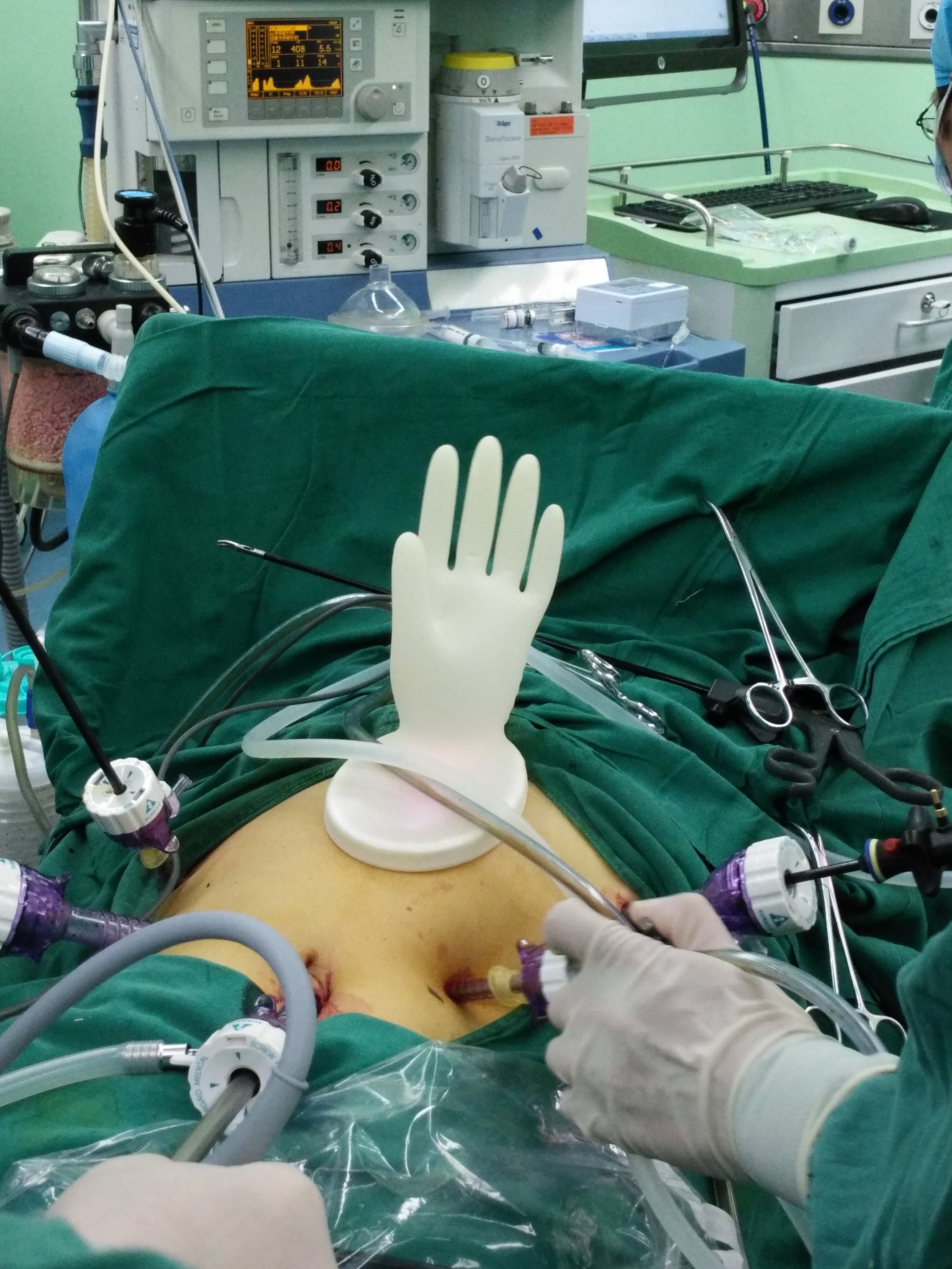 肝右静脉手术中下面简单向大家介绍一例肝内外胆管结石的微创手术病例