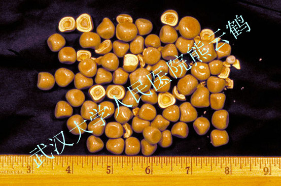 calcium_oxalate_kidney_stones10.jpg