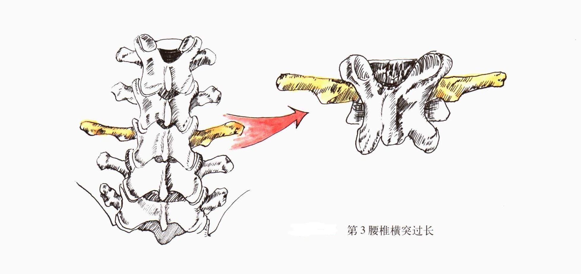 腰腿疼痛不止是腰椎间盘突出症 也可能是它 腰腿痛 腰腿痛病因