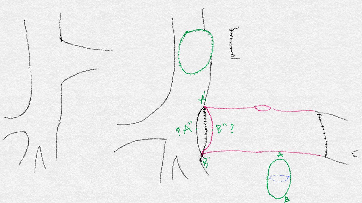 外院glenn术后行二期fontan手术(4岁)
