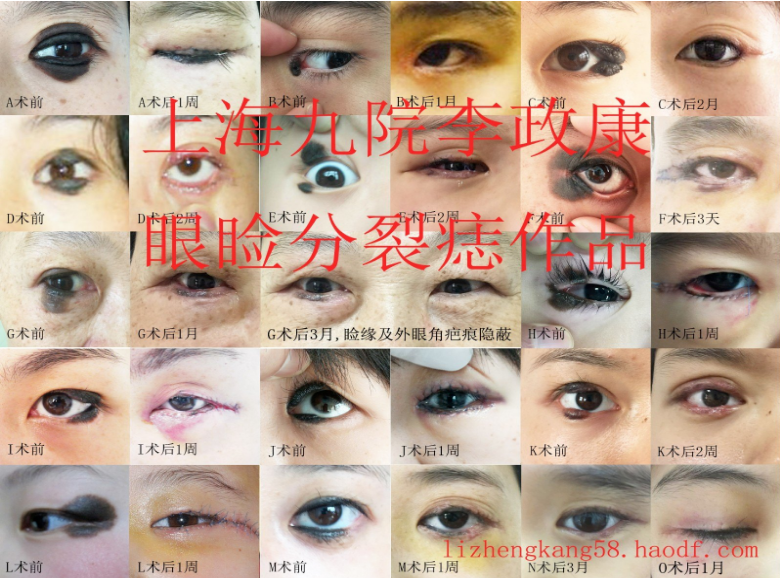 李政康手术治疗眼睑分裂痣的作品展示含病例图片