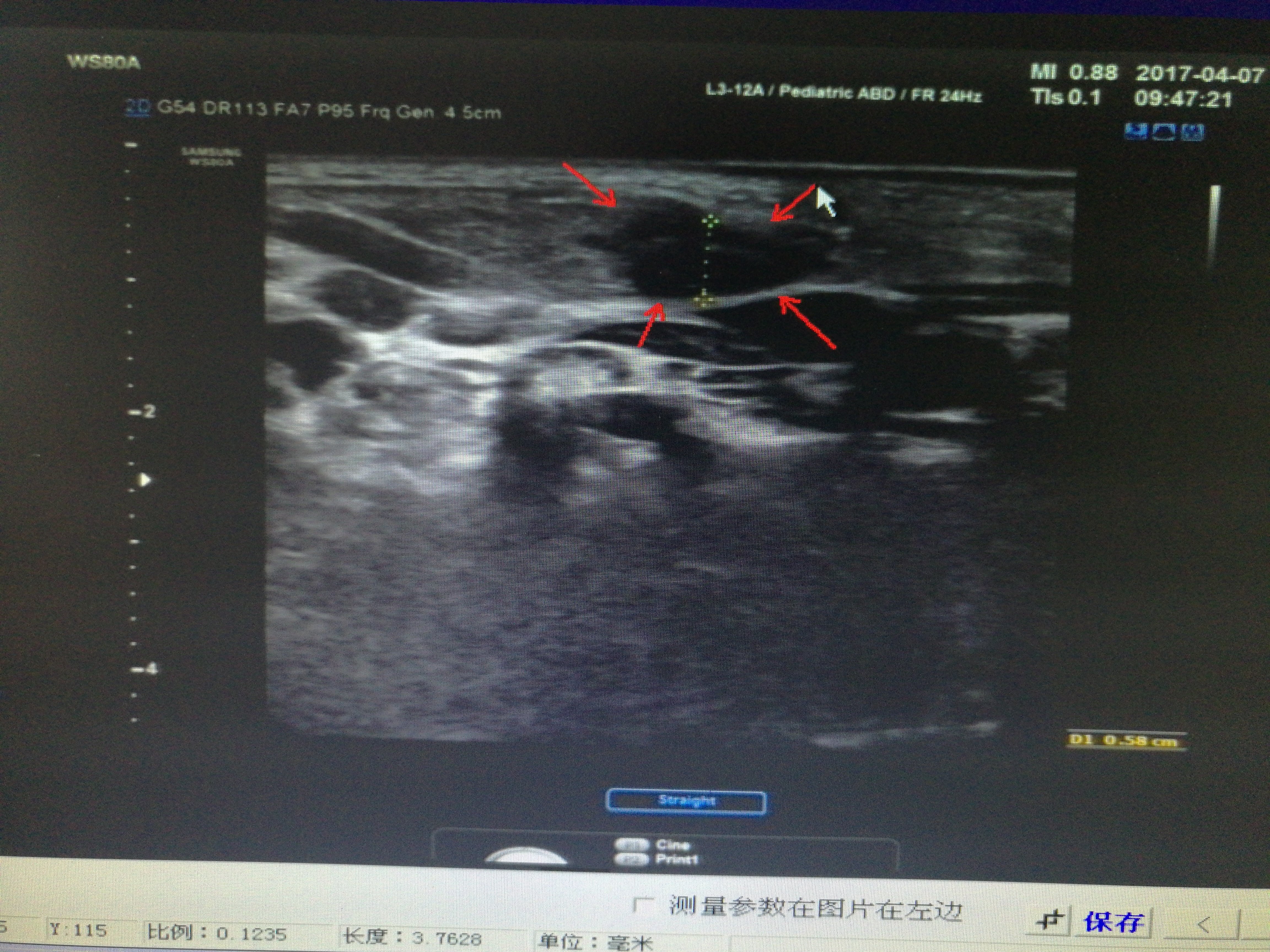 小儿斜颈术后肌肉粘连合并渗液1例