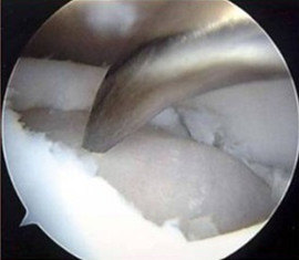 膝关节软骨损伤怎么办 好大夫在线 膝关节软骨损伤怎么办 好大夫在线