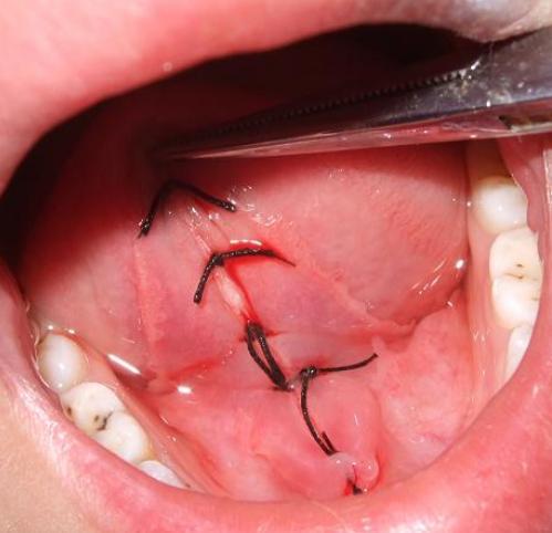 舌系带手术基本知识