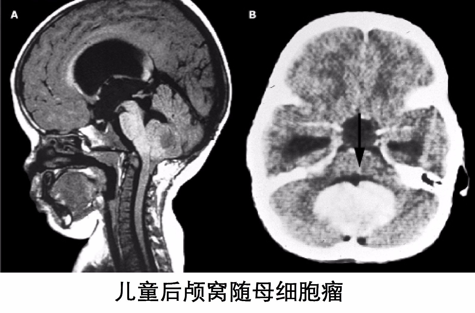 髓母细胞瘤不是胶质瘤