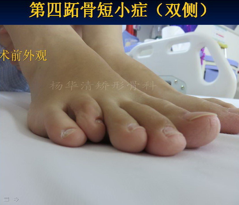 第四跖骨短小症双足典型病例
