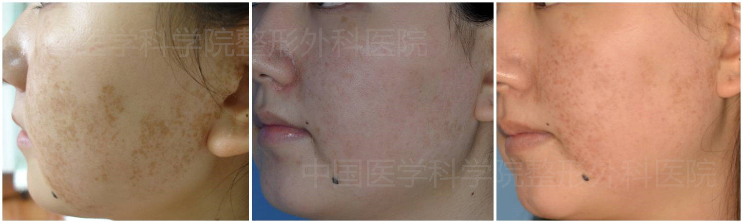 激光治疗——雀斑样痣——2次治疗 - 好大夫在线