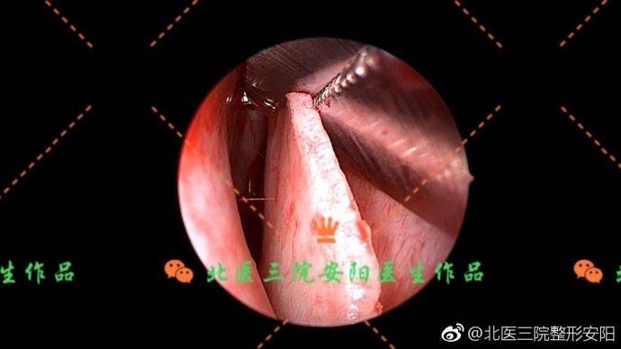 鼻中隔三线减张矫正术图片