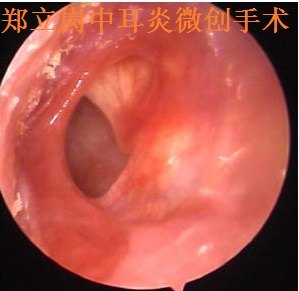 前言:中耳炎微創手術是目前治療慢性化膿性中耳炎及膽脂瘤型中耳炎最