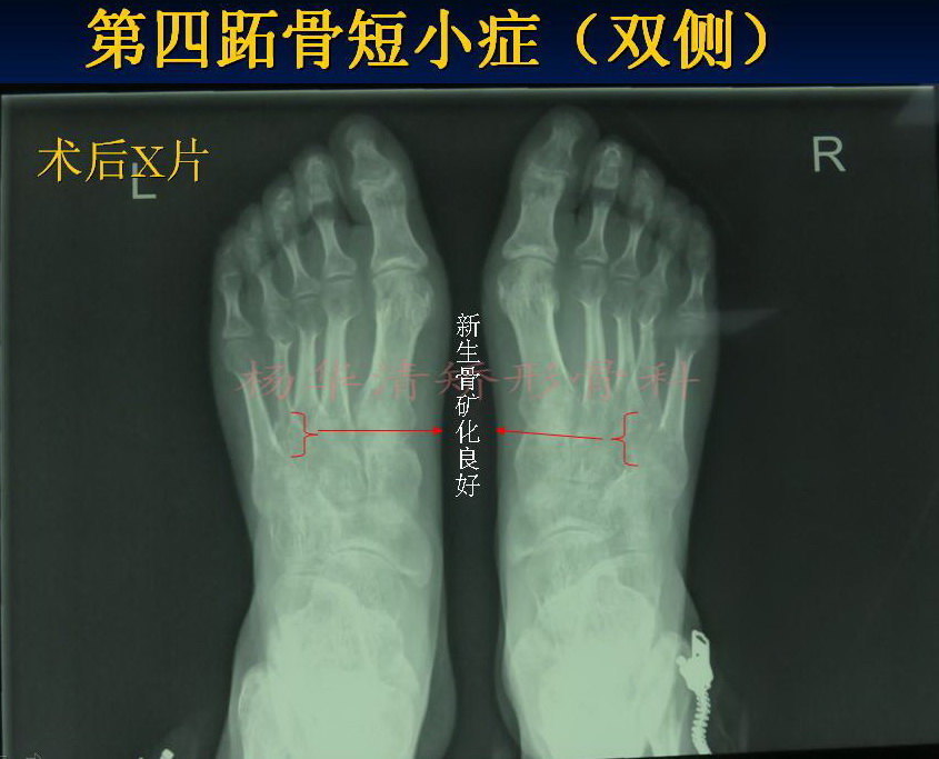 第四跖骨骨折图片