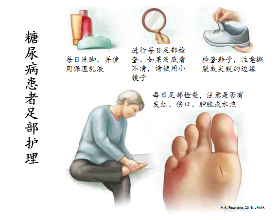 糖尿病患者,关注足部健康(二) - 好大夫在线