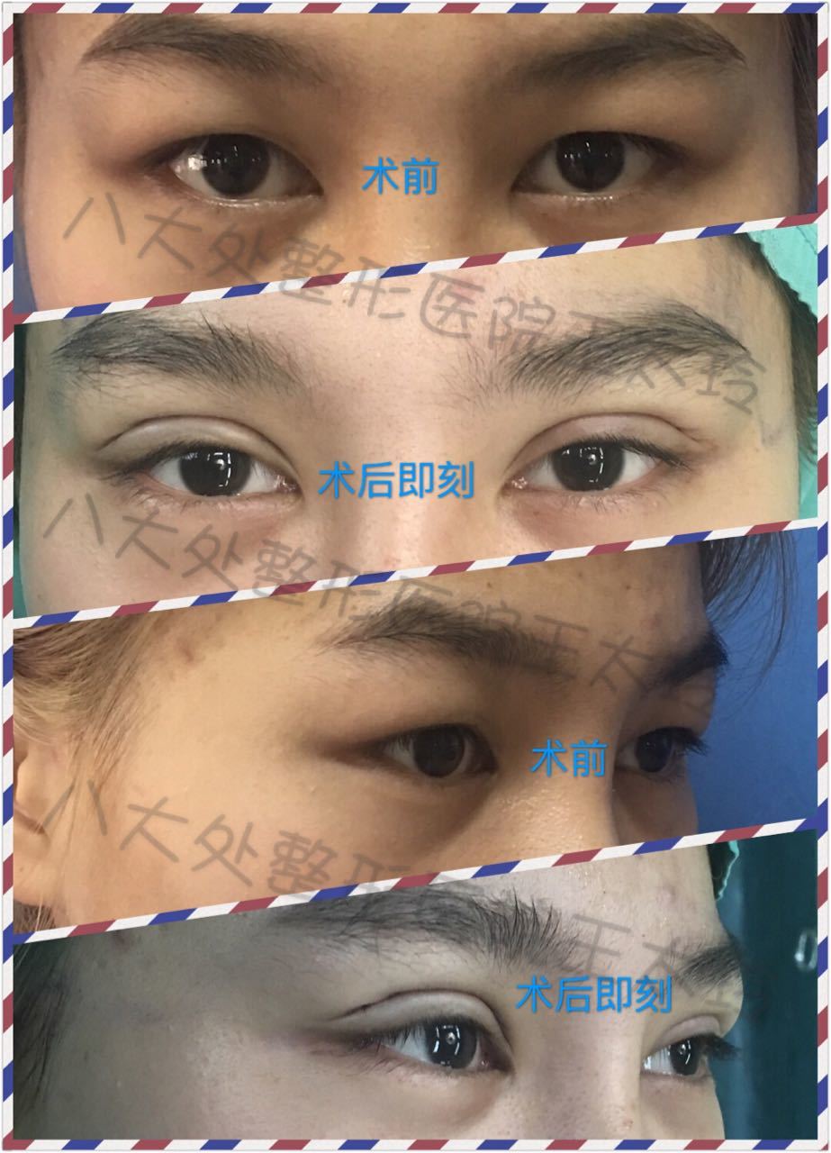 王太玲医生三点微创双眼皮案例分享-1-5 - 好大夫在线