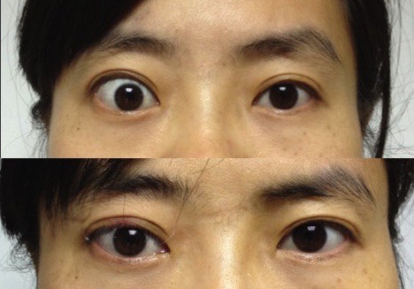 甲亢突眼手术前后对比图片