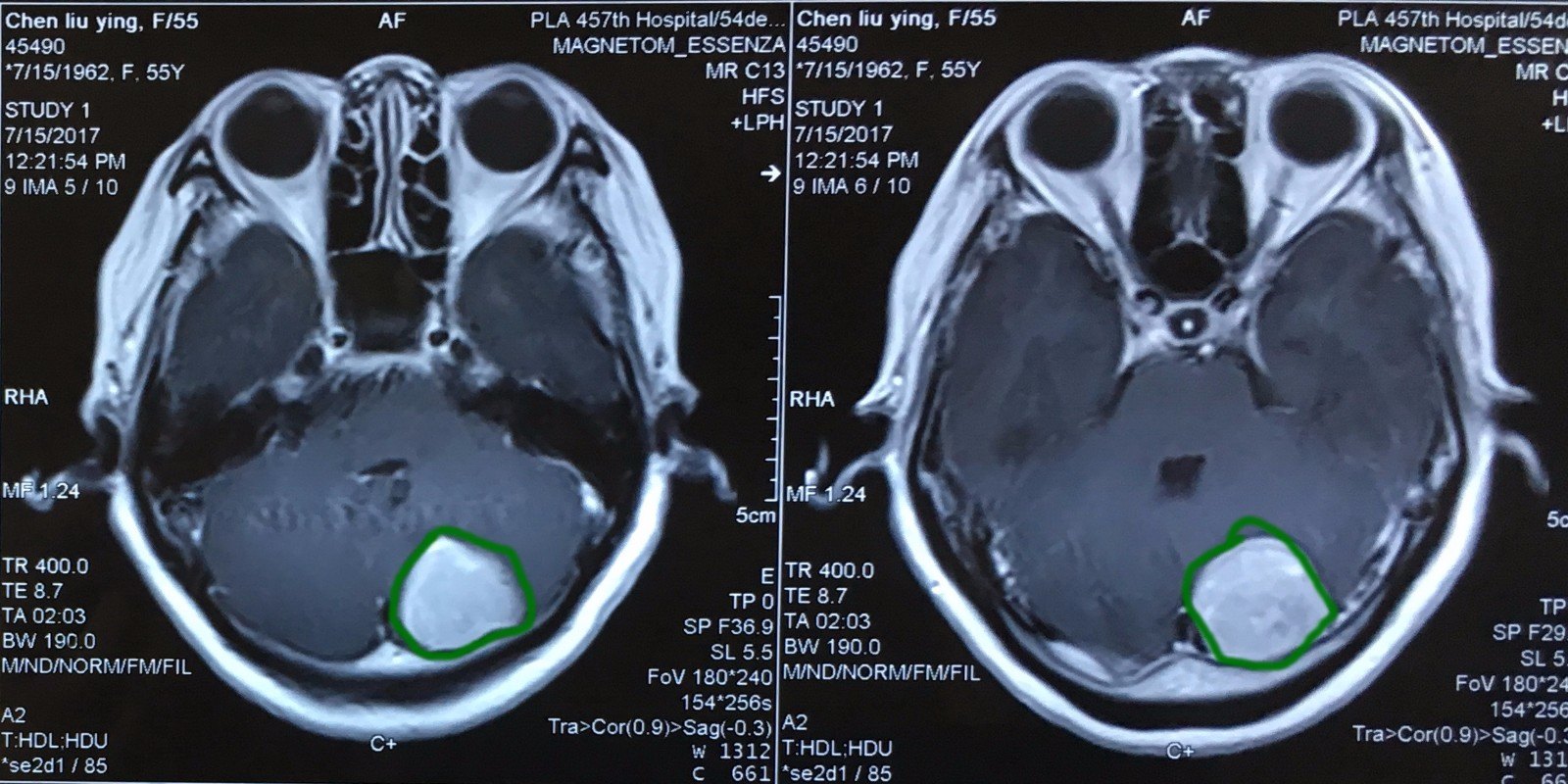 横窦-天幕脑膜瘤全切一例 - 好大夫在线