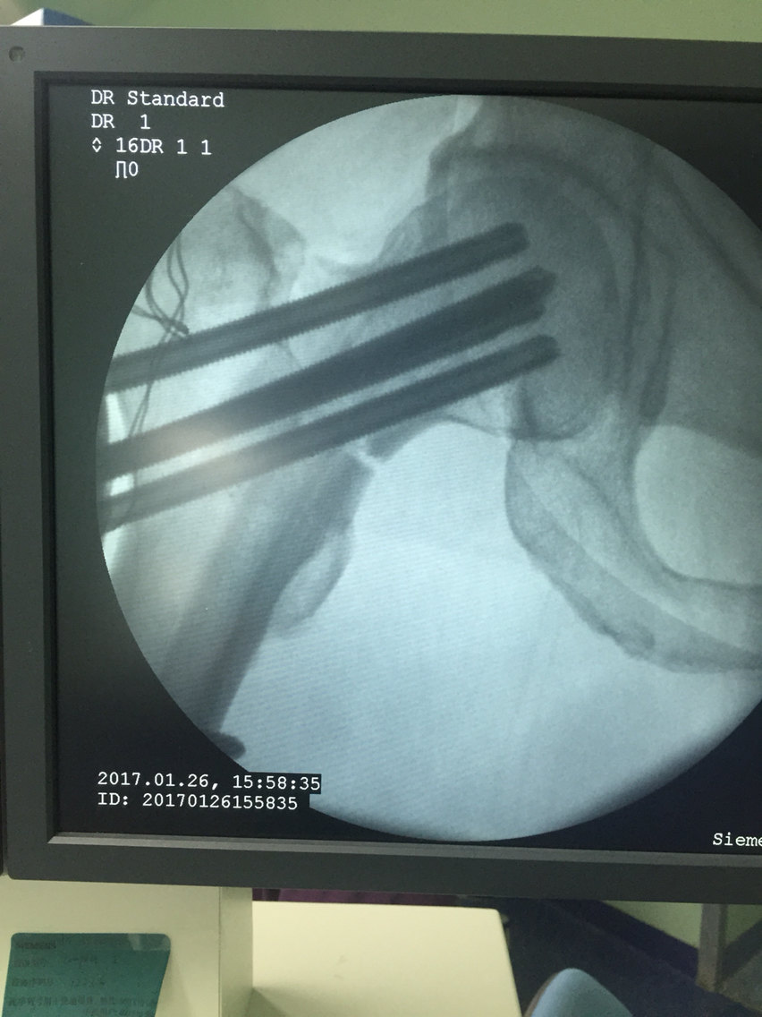 外傷後12小時閉合復位 空心螺釘內固定32歲左股骨頸基底部骨折合併
