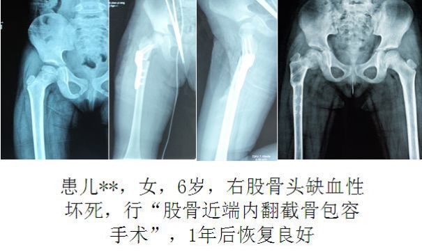 小儿股骨头坏死_小儿股骨头坏死疾病介绍 - 好大夫在线