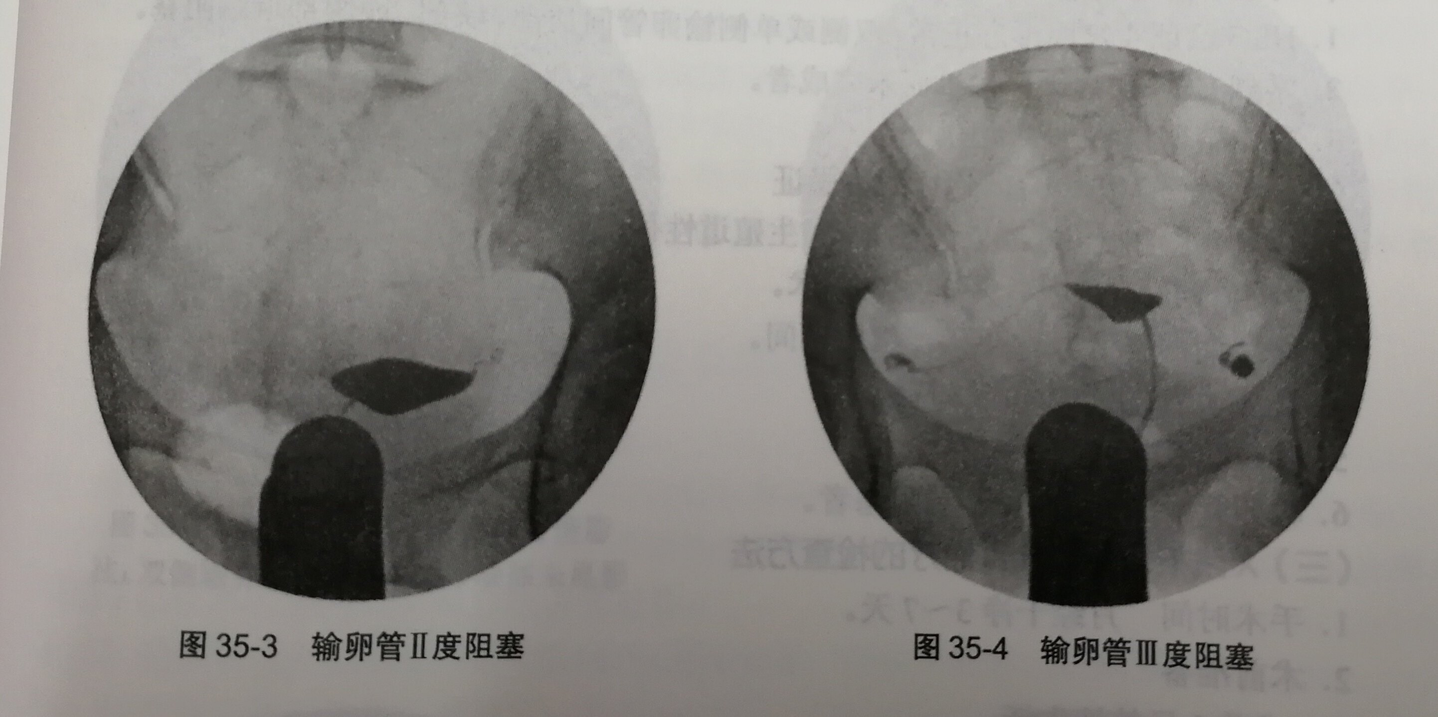 (資料及圖片來自連方教授主編《形饕澆岷仙騁窖А)③重度輸卵管