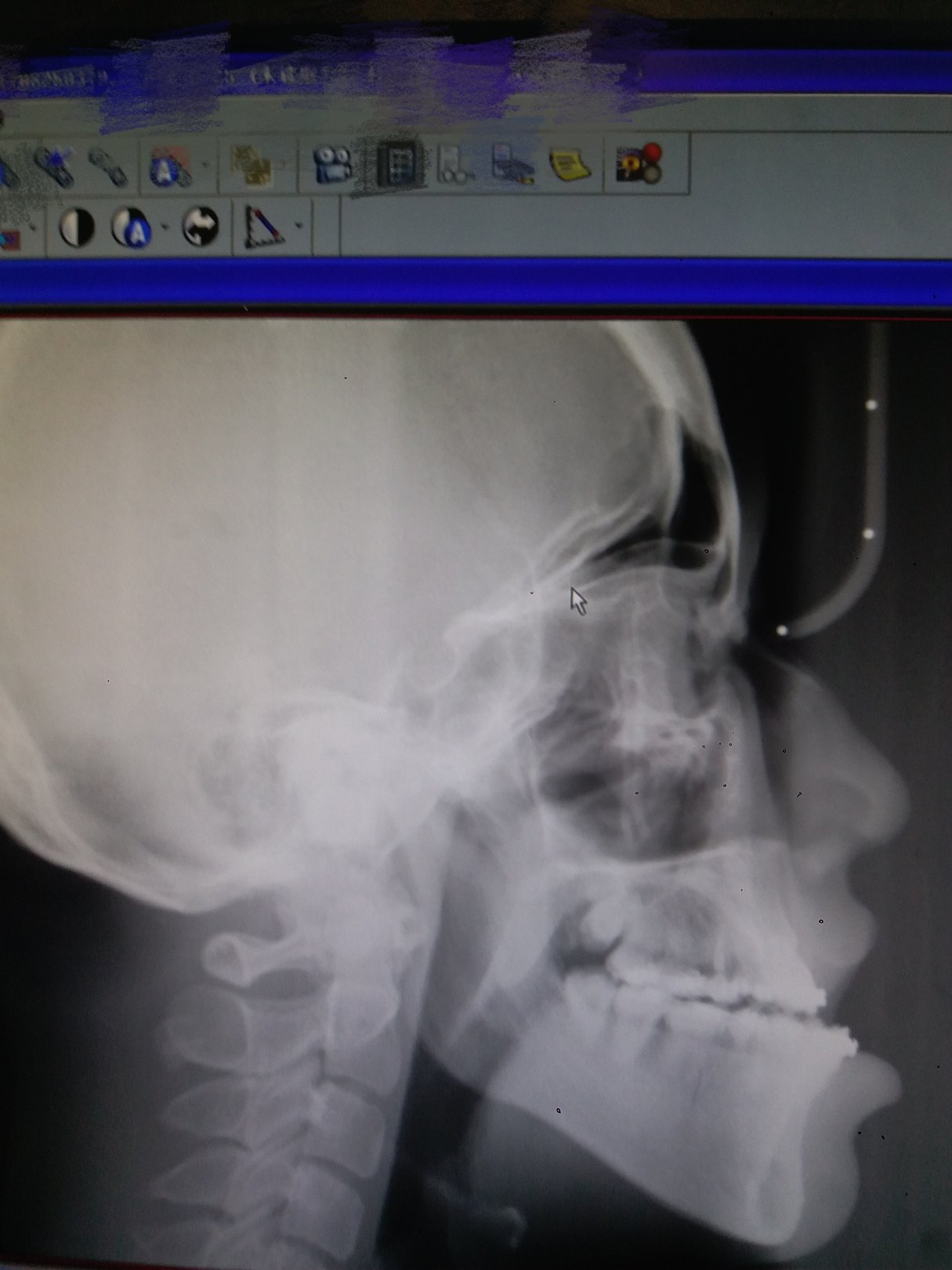 正颌手术治疗颌骨畸形