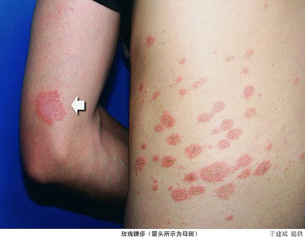 玫瑰糠疹的症状和图片图片