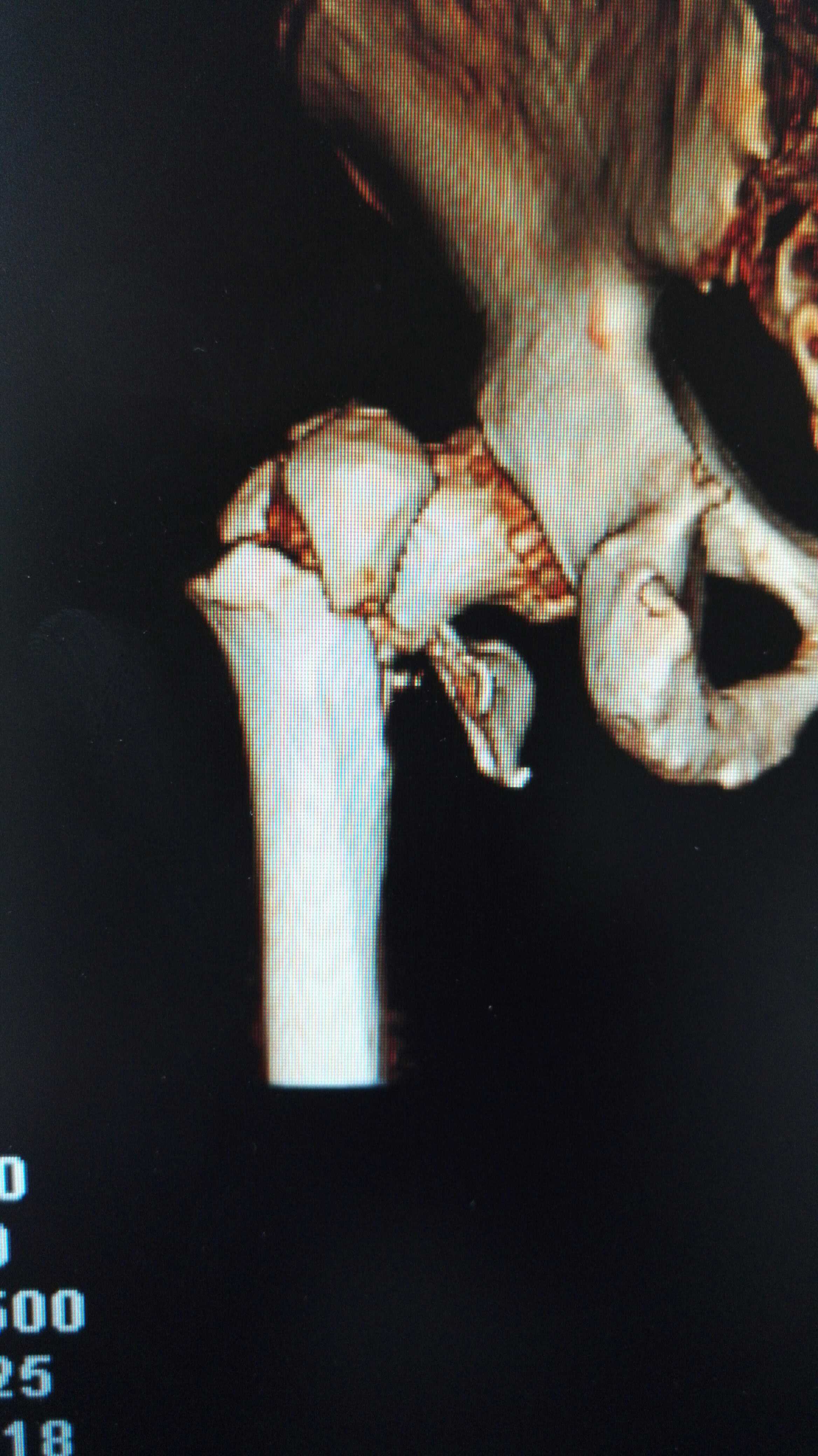 可怕的老年髋部骨折 - 好大夫在线