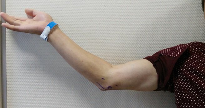 看关节镜"解锁"------祛肘关节挛缩