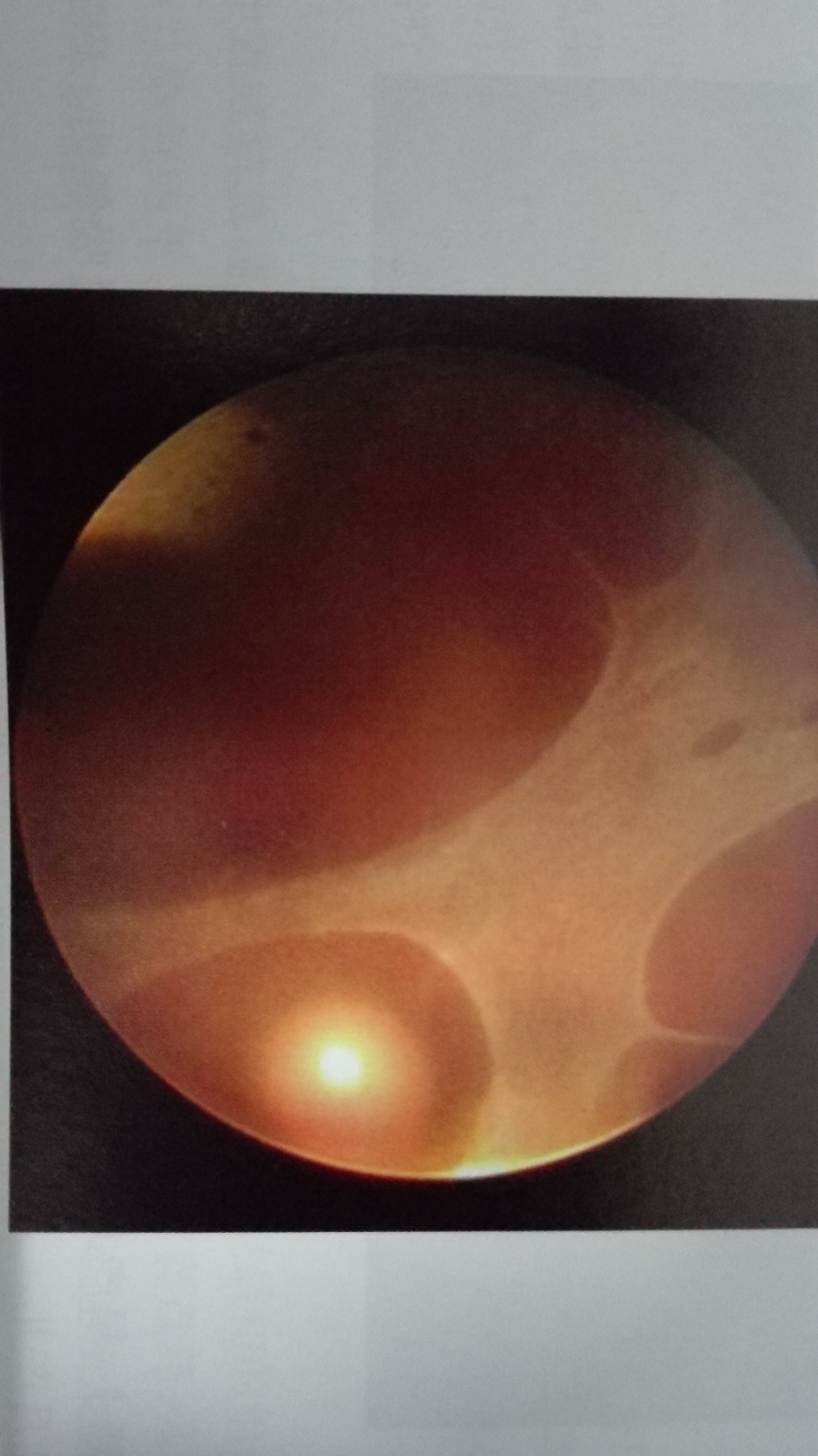 什么是遗传性视网膜劈裂症 - 好大夫在线