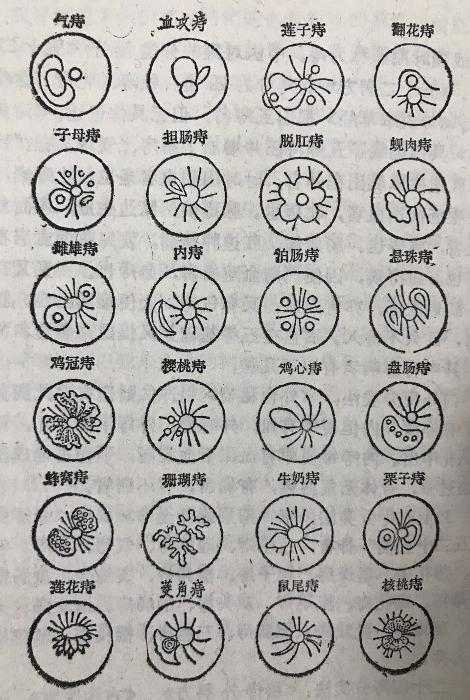 内痔大便形状图,内痔形状扁平,内痔图片和外痔图片_大山谷图库
