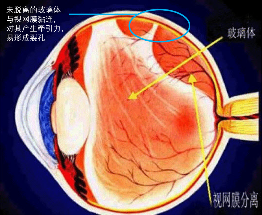 視網膜裂孔的臨床表現及防治