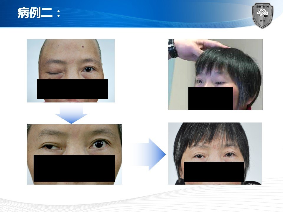 眶上裂综合症的微创手术治疗 - 好大夫在线