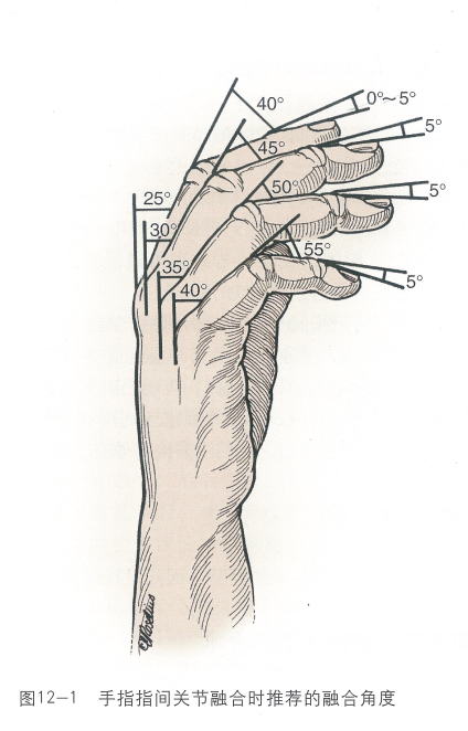 手部关节的融合角度选择 - 好大夫在线